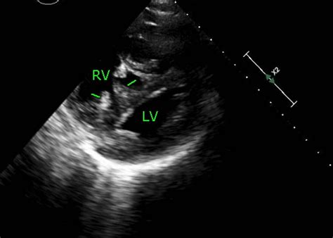 d shaped lv echo